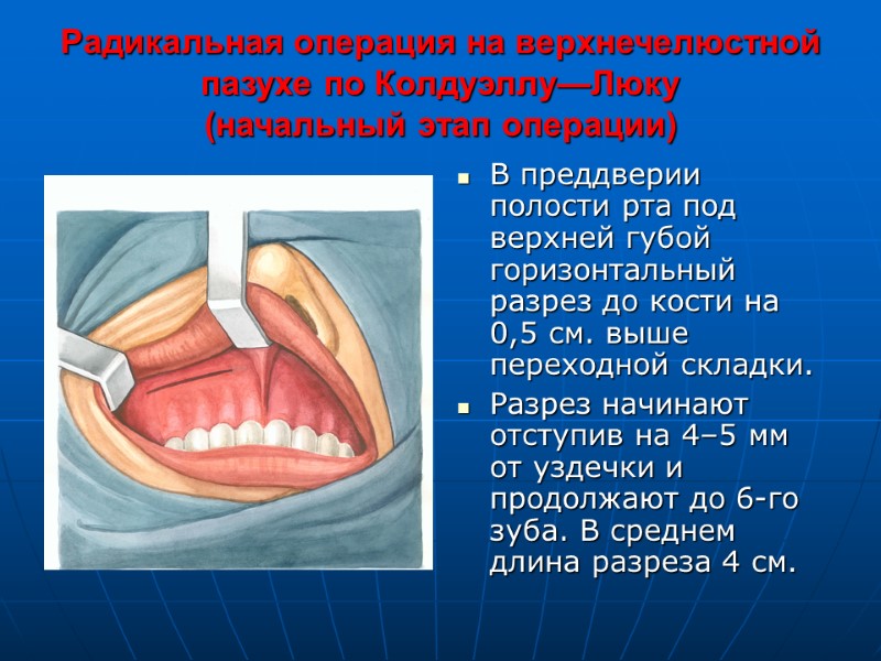 Радикальная операция на верхнечелюстной пазухе по Колдуэллу—Люку  (начальный этап операции) В преддверии полости